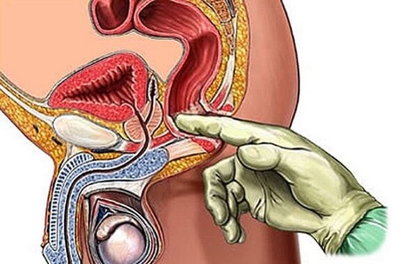 Prostatit tedavisinin bir yolu olarak prostat masajı