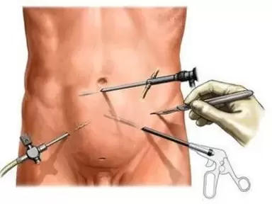 kronik prostatitin cerrahi tedavisi