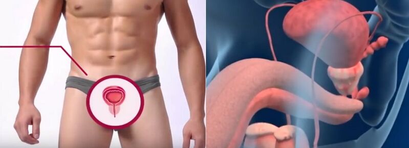 Erkeklerde belirli belirtilerle tanınabilen prostatit
