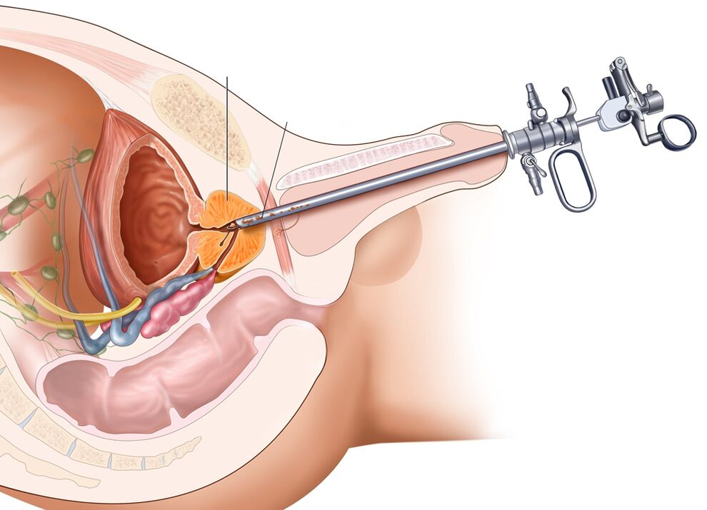 Prostatın transüretral rezeksiyonu, organın etkilenen kısımlarını çıkarmanıza izin verir. 