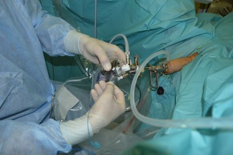 Kronik prostatitte organın bir kısmını çıkarmak için prostatın transüretral rezeksiyonu